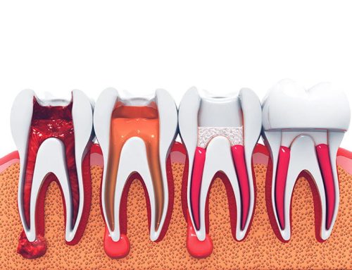 Root Canal Treatment: What you need to know
