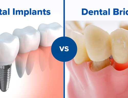 Dental Implants vs. Bridges: What’s best for you?