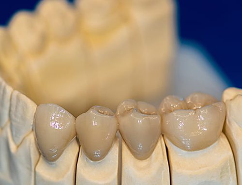 Misconceptions about dental crowns