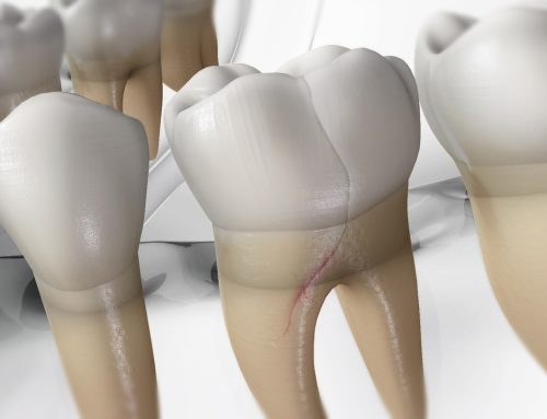 Everything to Know About Cracked Tooth Syndrome