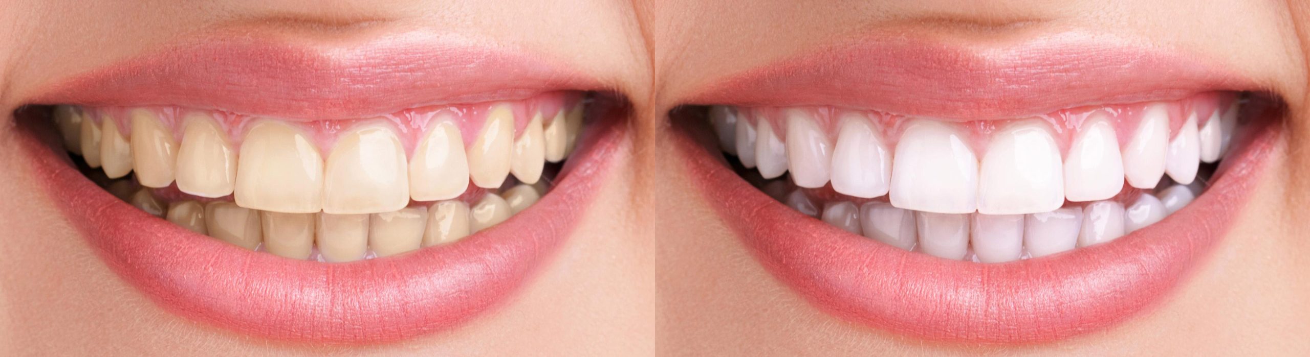 Чистка зубов улан удэ. Отбеливание зубов до и после. Зубы до и после отбеливания.
