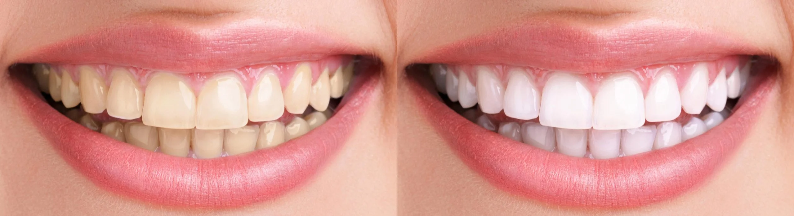 UV/Laser Teeth Whitening in Scarborough From Awarded Best Dentist