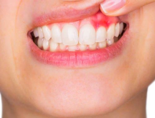 Pus from teeth or gum? Learn more about Dental Abscess