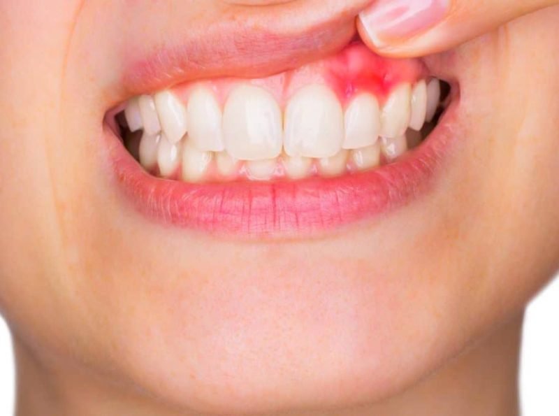 Pus from teeth or gum? Learn more about Dental Abscess Dr. Salim