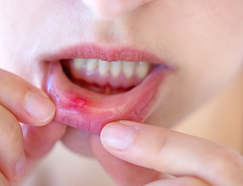 Mouth Sores: Causes, Symptoms & Treatment