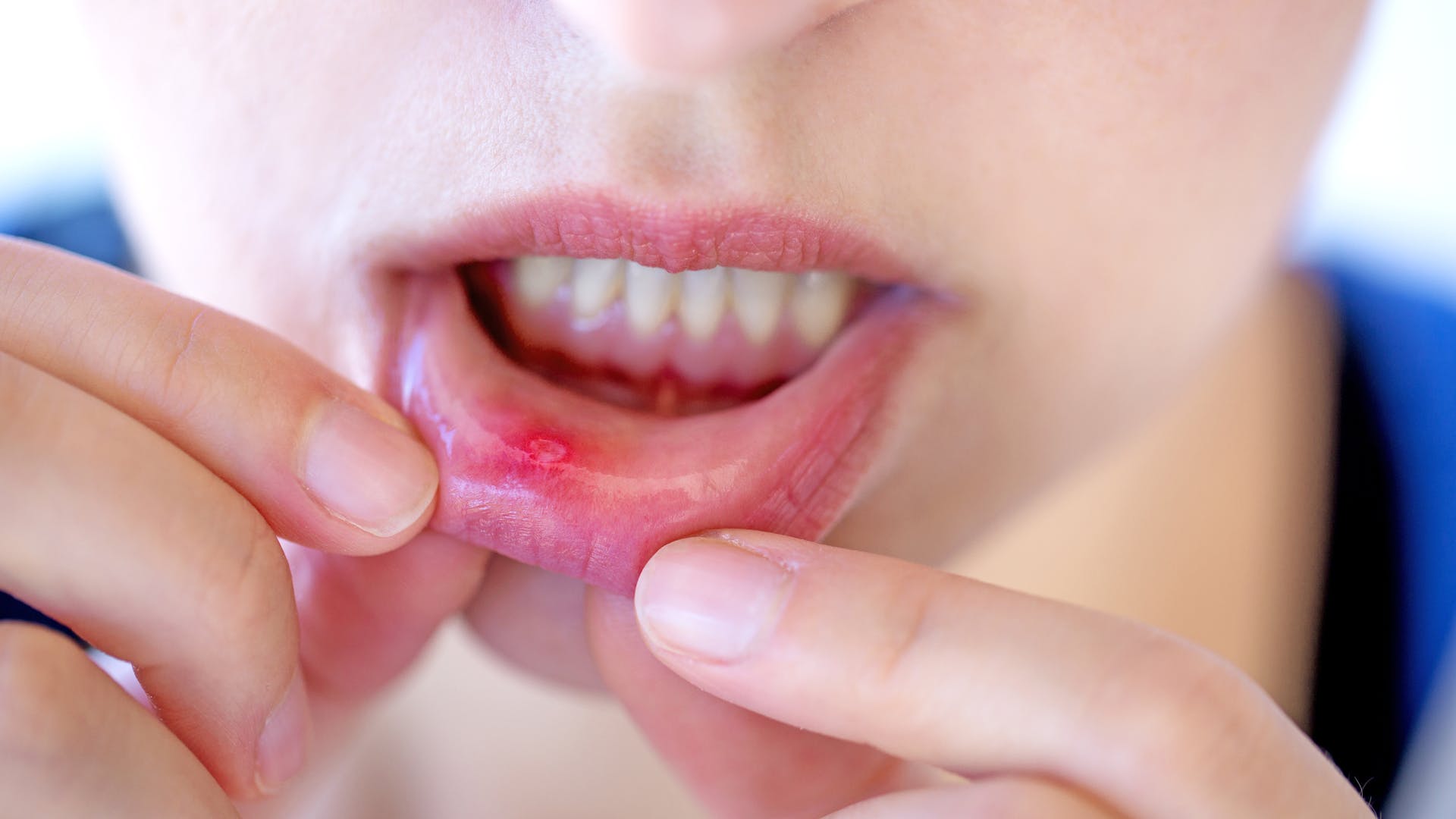 What Causes Cold Sores All Over Lips