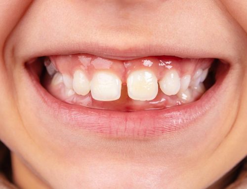 Gap between teeth: Ways to fix Diastema
