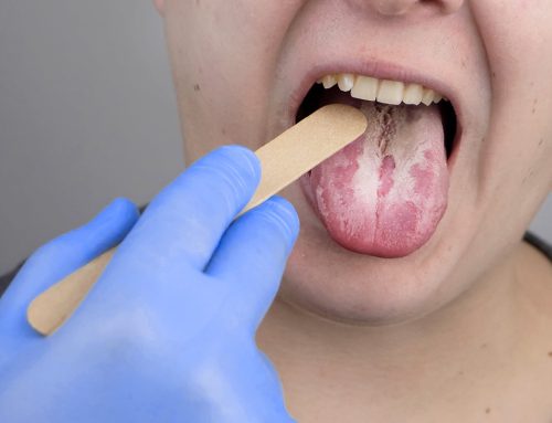 Everything you need to know about Oral Thrush?