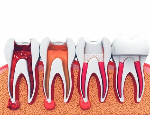 Common myths and facts about the root canal treatment