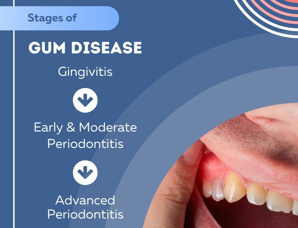 Why Jaw Popping Happens and How to Fix It - Dr. Salim Kapadia Dental Centre