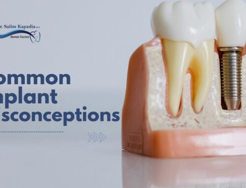 Choosing Dental Implants: Debunking Common Misconceptions
